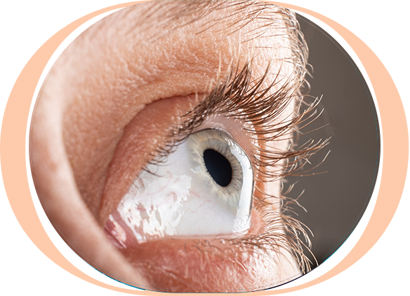 Imagem Cirurgia Refrativa